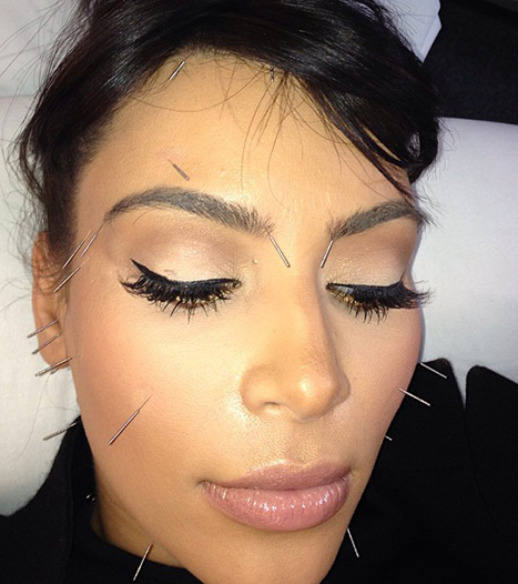 kim-kardashian-acupuncture